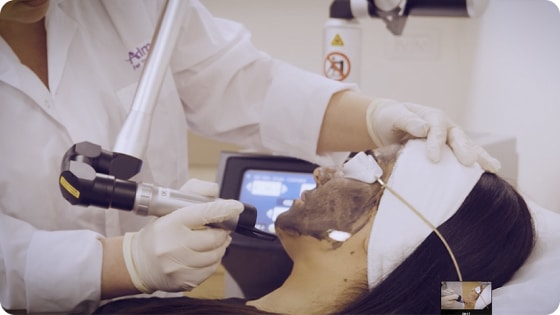 Carbon Laser Peel and the Many Names for One Popular Treatment Carbon Laser Peel and the Many Names for One Popular Treatment