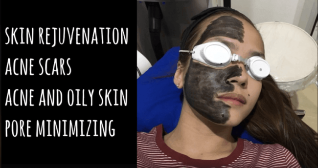 Who can benefit from a carbon laser peel treatment? Who can benefit from a carbon laser peel treatment?