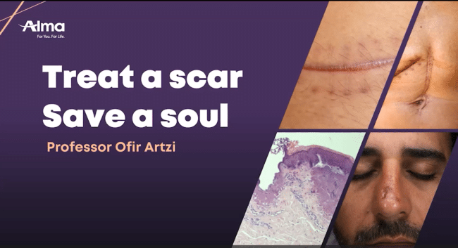 Scar management in the Hybrid era: A combined approach to the treatment of scars. Scar management in the Hybrid era: A combined approach to the treatment of scars.