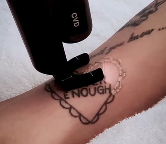 How Does Laser Tattoo Removal Work?
